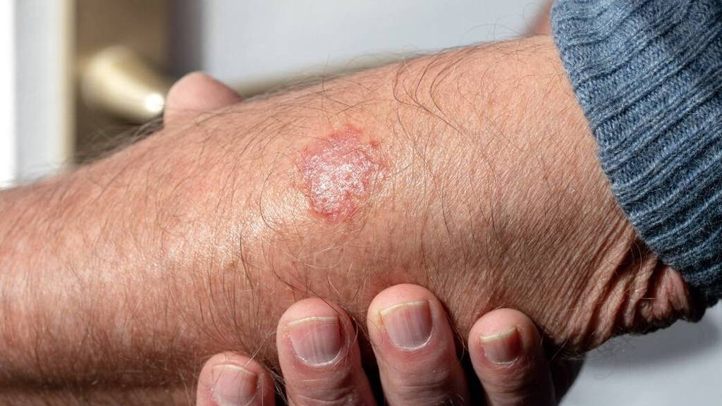 eczema on the arm of a man