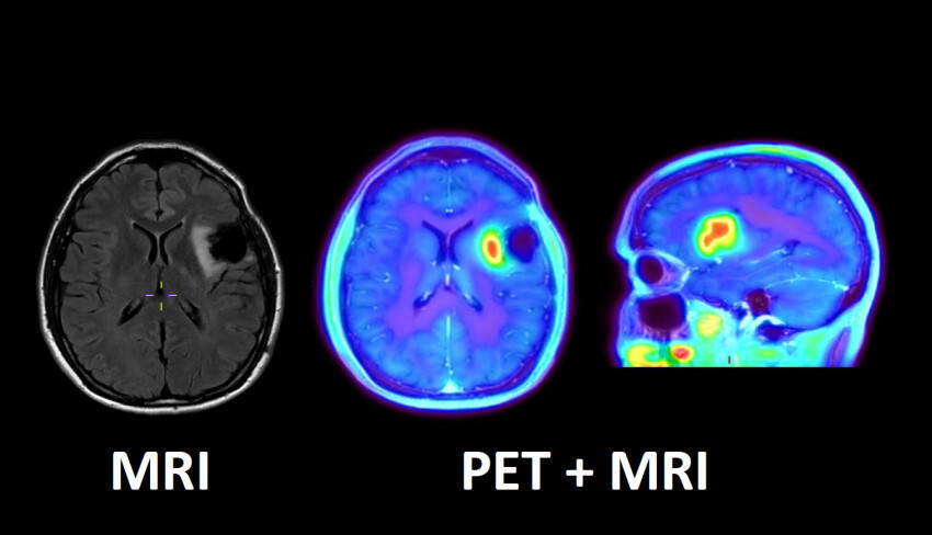 FET PET-MRI met tekst